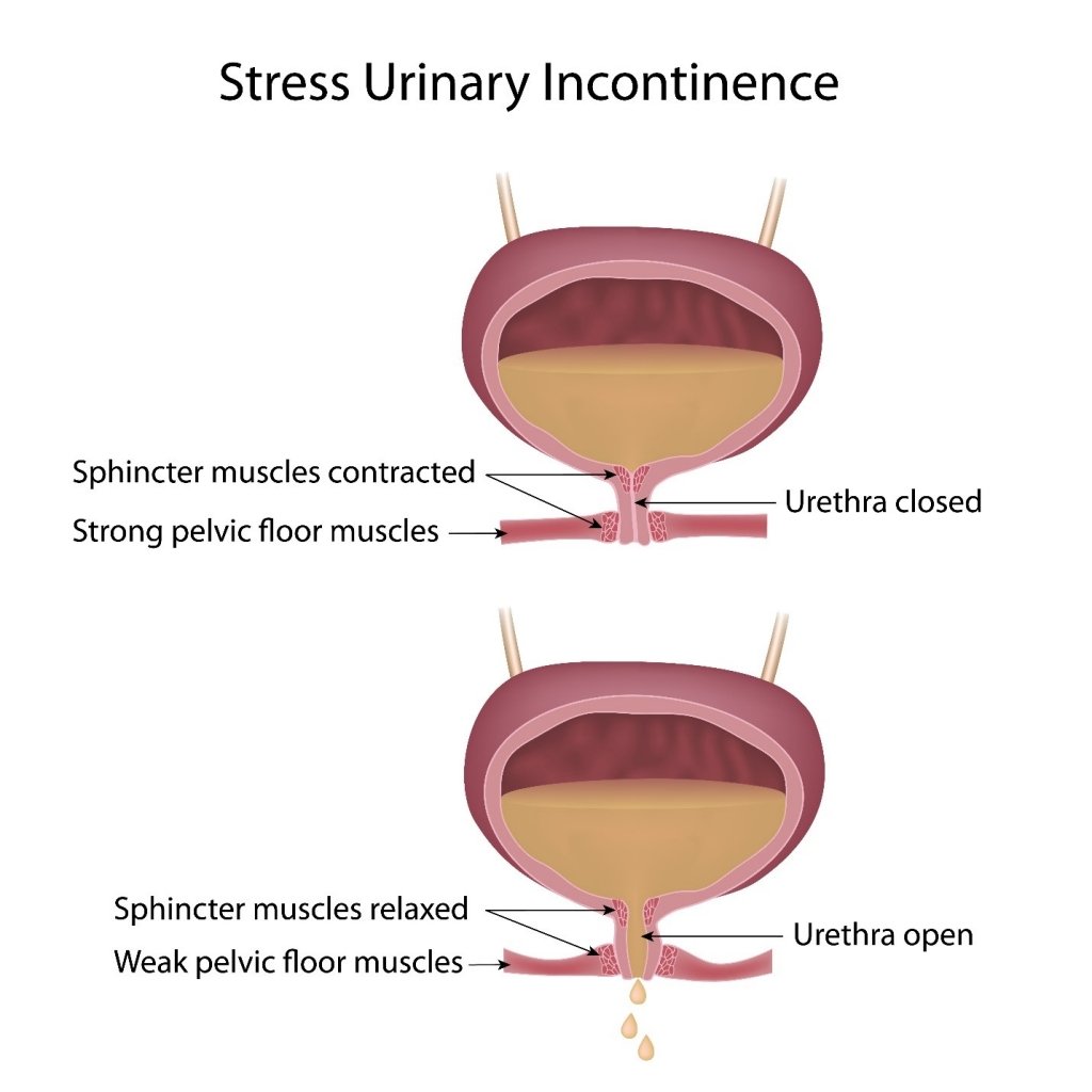 diagram showing effects of stress on urinary incontinence