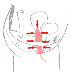 pressure against device in uterus 